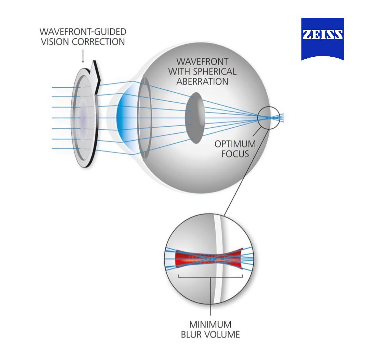 ZEISS i.Scription: นวัตกรรมเลนส์เฉพาะบุคคลกับการดูแลระดับพรีเมียมที่ Supparerk Vision